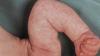 Pielea „de marmură” la bebeluși: normă sau patologie? Neurologul răspunde