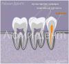 Cum să găsiți și să tratați canalele dentare în Lumident