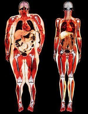 Stânga - doar viscerala obezitate. Toate organele sufocat cu grăsime.