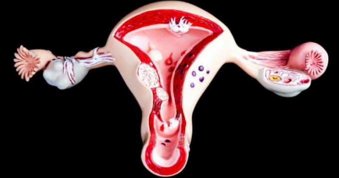 Cancerul de col uterin - cancerul de col uterin
