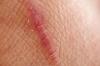 Cicatricile pielii: ce este și cum să le eliminați