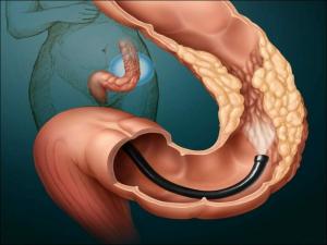 Sindromul Payra, interferează cu funcționarea normală a intestinului