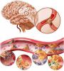 Ateroscleroză cerebrală: cum să trateze, care sunt simptomele?