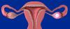 Chisturile ovariene: 4 simptom de alarmă