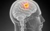 Simptomele de tumoare pe creier incipiente