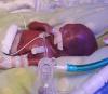 Cel mai prematur bebeluș din lume
