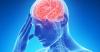 Riscul de accident vascular cerebral: 2 găsit noua caracteristică
