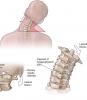 4 exerciții de bază pentru a coloanei vertebrale cervicale va ajuta să uite durerea și osteochondrosis!