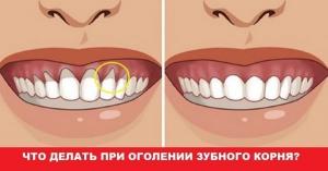 Cum de a trata gingiilor atunci când dintii devin gât goale?