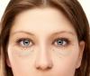 Cum sa scapi de fara interventie chirurgicala, o hernie si pleoapele inferioare pungi ochi