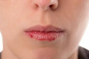 5 sfaturi cu privire la modul de a preveni chapping buzelor